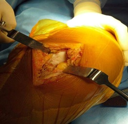 operative_partial_knee1-1