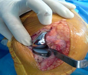 operative_partial_knee2-1